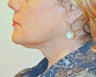 57 Year ol female treated with Ultherapy