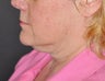 57 Year ol female treated with Ultherapy