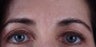 Botox to forehead "11" lines