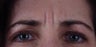 Botox to forehead "11" lines