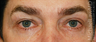 Eye Bag Surgery