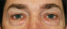 Eye Bag Surgery