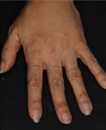 Radiesse to Hands