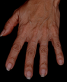 Radiesse to Hands