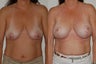 Breast Augmentation and Lift