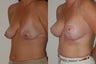 Breast Augmentation and Lift