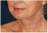 Facelift
