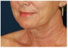 Facelift