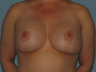 Patient underwent a Breast Lift.