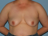 Patient underwent a Breast Lift.
