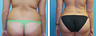 Liposuction Before & After