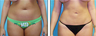 Liposuction Before & After