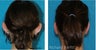 Otoplasty for Young Girl