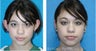 Otoplasty for Young Girl