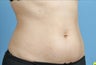 truSculpt
