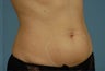 truSculpt