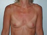 Female patient who underwent breast reconstruction