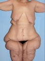 50 Year Old Female Extreme Makeover Body Lift
