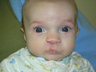 Pediatric Cleft Lip and Palate Repair Surgery