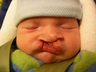 Pediatric Cleft Lip and Palate Repair Surgery
