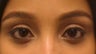 Restylane to the tear trough