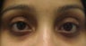 Restylane to the tear trough