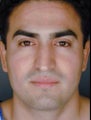 Male Primary Rhinoplasty