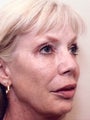 Non Surgical Facelift