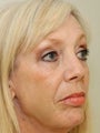 Non Surgical Facelift