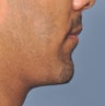 38 Year Old Male Treated For A Small Chin