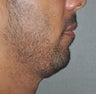 38 Year Old Male Treated For A Small Chin