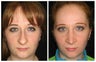 Rhinoplasty