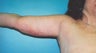 44 year old woman who underwent an arm lift