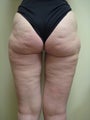 50 year old female before and after SmartLipo of her thighs