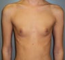 19 year old saline breast enhancement