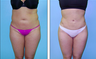 Liposuction Before & After