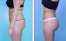 Liposuction Before & After