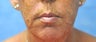 66 Year Old Female Treated for Unacceptable Cosmetic Appearance of the Face