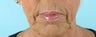 66 Year Old Female Treated for Unacceptable Cosmetic Appearance of the Face