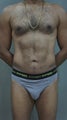 41 yr old for body sculpting.