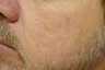 Laser Genesis