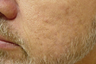 Laser Genesis