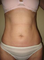 Smart Lipo