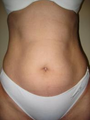 Smart Lipo