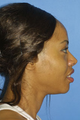 Ethnic Rhinoplasty