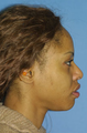 Ethnic Rhinoplasty