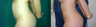 Liposuction on abdomen, flanks and back