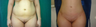 Liposuction on abdomen, flanks and back