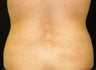 CoolSculpting