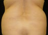CoolSculpting